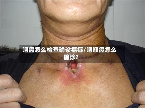 咽癌怎么检查确诊癌症/咽喉癌怎么确诊?