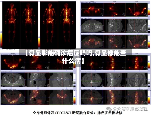 【骨显影能确诊癌症吗吗,骨显像能查什么病】