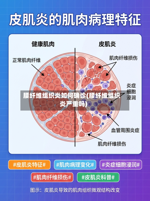 腰纤维组织炎如何确诊(腰纤维组织炎严重吗)